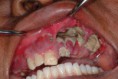 /album/fotogaleria/efectos-de-la-droga-krokodil-4-jpg/